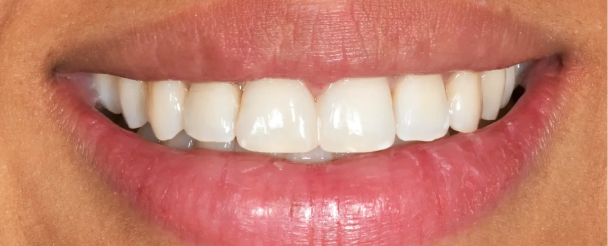 America's Bright Smiles in Pompano Beach, FL Treatment case study, after — America's Bright Smiles, Pompano Beach, FL