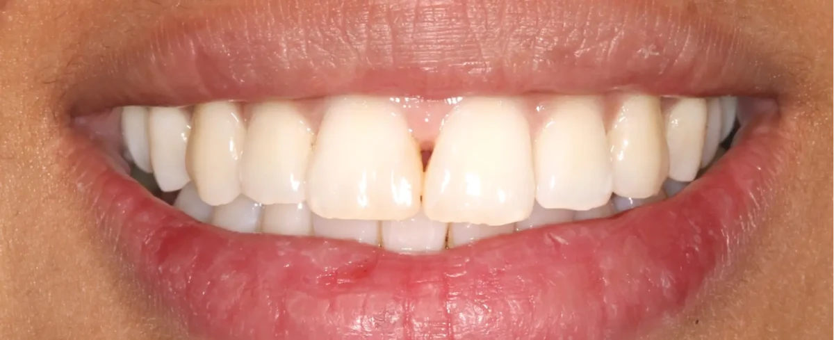 America's Bright Smiles in Pompano Beach, FL Treatment case study, before — America's Bright Smiles, Pompano Beach, FL
