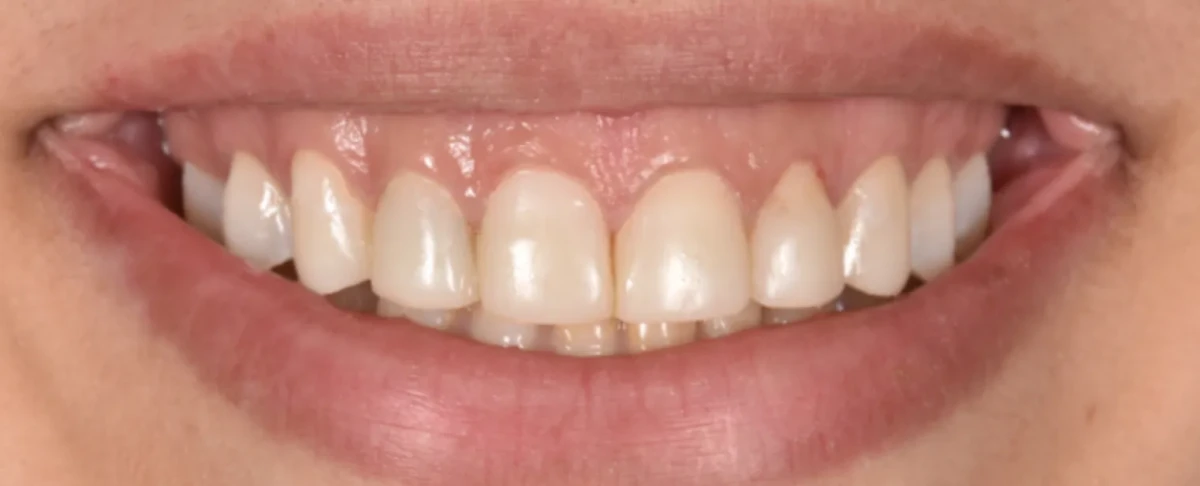 America's Bright Smiles in Pompano Beach, FL Treatment case study, after — America's Bright Smiles, Pompano Beach, FL