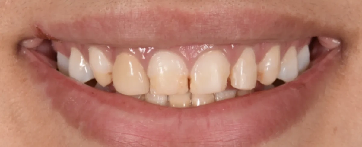 America's Bright Smiles in Pompano Beach, FL Treatment case study, before — America's Bright Smiles, Pompano Beach, FL