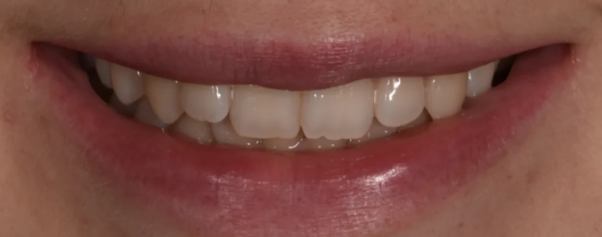 America's Bright Smiles in Pompano Beach, FL Treatment case study, before — America's Bright Smiles, Pompano Beach, FL