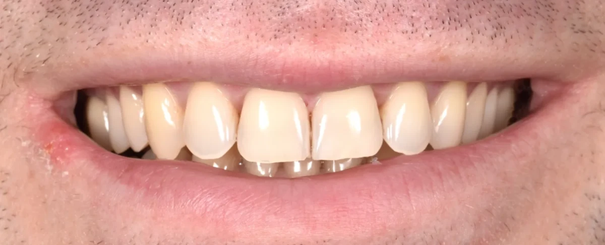 America's Bright Smiles in Pompano Beach, FL Treatment case study, after — America's Bright Smiles, Pompano Beach, FL