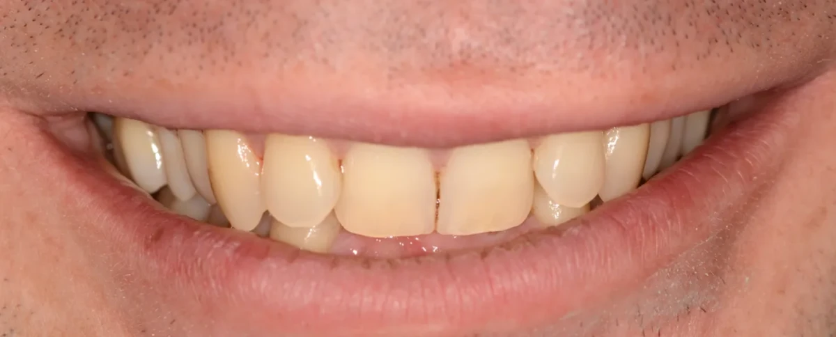 America's Bright Smiles in Pompano Beach, FL Treatment case study, before — America's Bright Smiles, Pompano Beach, FL