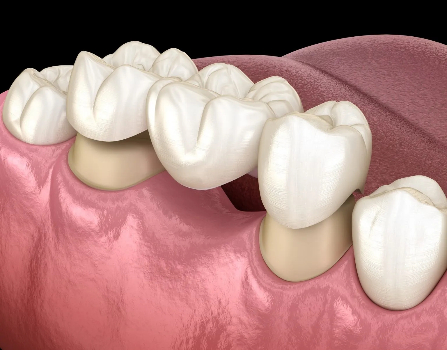 Understanding Dental Bridges Pompano Beach FL