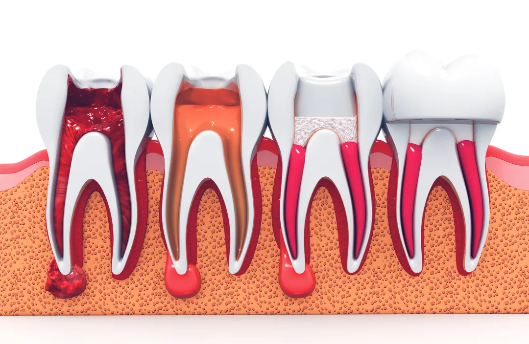Benefits of Root Canal Treatment Pompano Beach FL