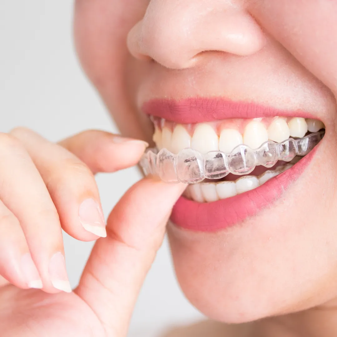 How Clear Aligners Work Pompano Beach FL