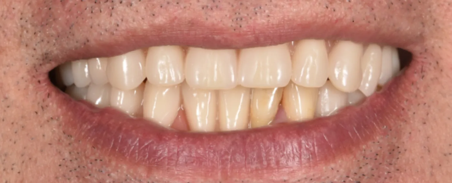 America's Bright Smiles in Pompano Beach, FL Dental crown case study, after — America's Bright Smiles, Pompano Beach, FL