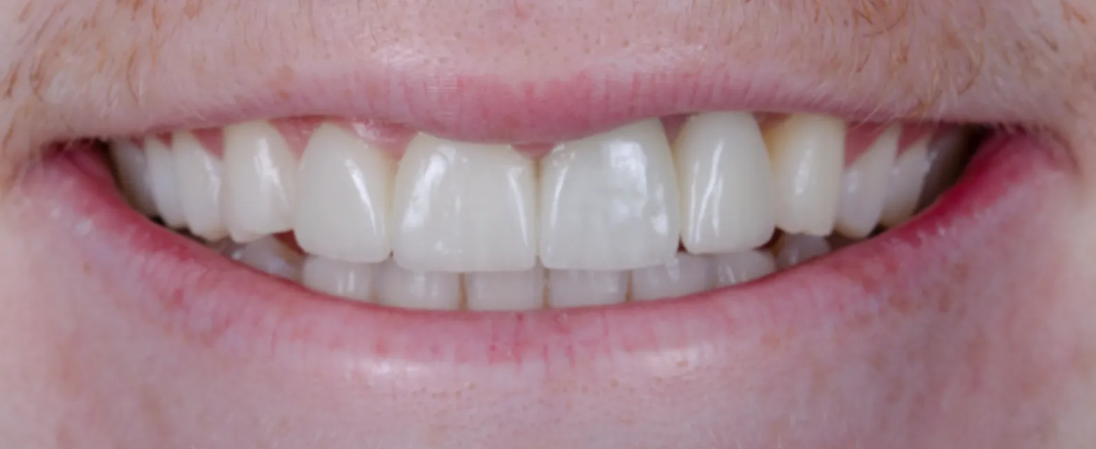 America's Bright Smiles in Pompano Beach, FL Dental crown case study, after — America's Bright Smiles, Pompano Beach, FL