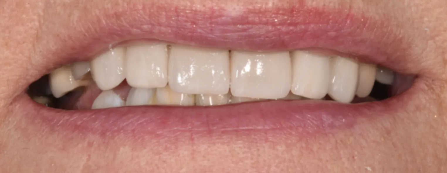 America's Bright Smiles in Pompano Beach, FL Dental crown case study, after — America's Bright Smiles, Pompano Beach, FL