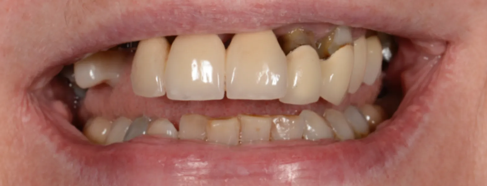 America's Bright Smiles in Pompano Beach, FL Dental crown case study, before — America's Bright Smiles, Pompano Beach, FL