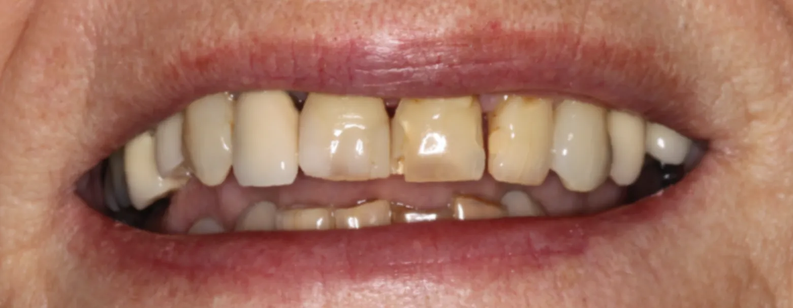 America's Bright Smiles in Pompano Beach, FL Dental crown case study, before — America's Bright Smiles, Pompano Beach, FL