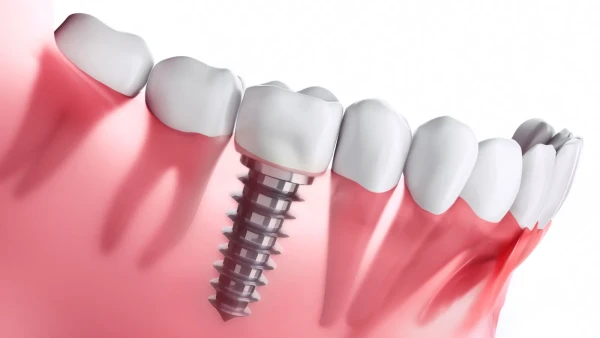Dental Implants Pompano Beach, FL