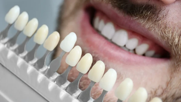Dental veneers at America's Bright Smiles, Pompano Beach, FL