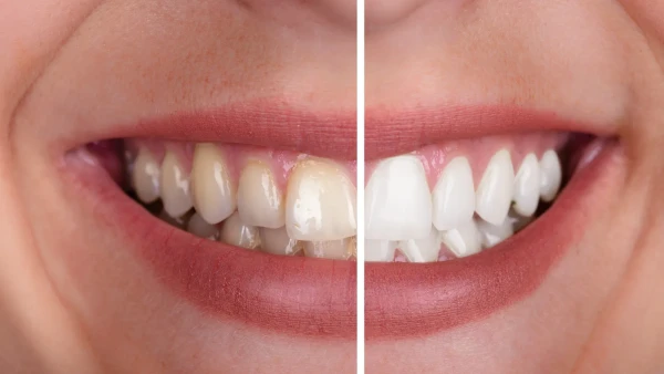 Teeth Whitening Pompano Beach FL